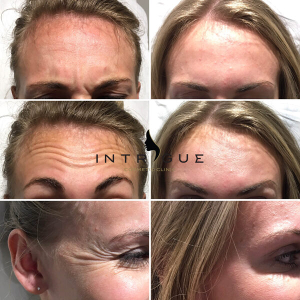 Treatment Results - Intrigue Cosmetic Clinic