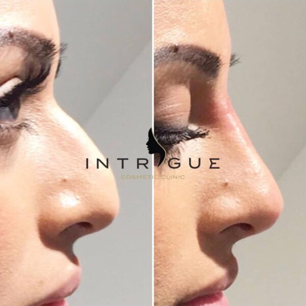 Treatment Results - Intrigue Cosmetic Clinic