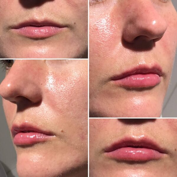 Treatment Results - Intrigue Cosmetic Clinic