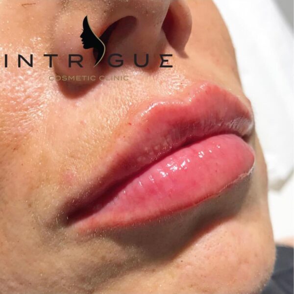 Treatment Results - Intrigue Cosmetic Clinic