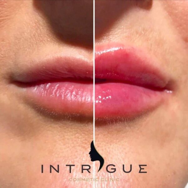 Treatment Results - Intrigue Cosmetic Clinic