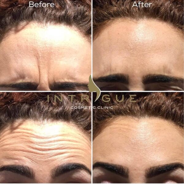 Treatment Results - Intrigue Cosmetic Clinic