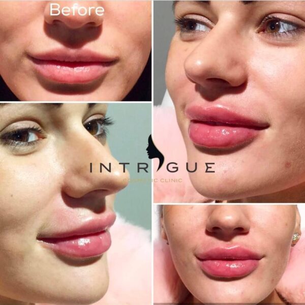 Treatment Results - Intrigue Cosmetic Clinic