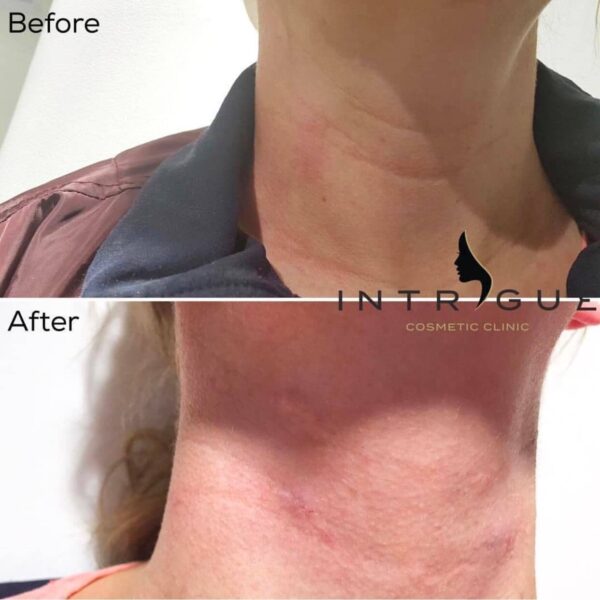 Treatment Results - Intrigue Cosmetic Clinic