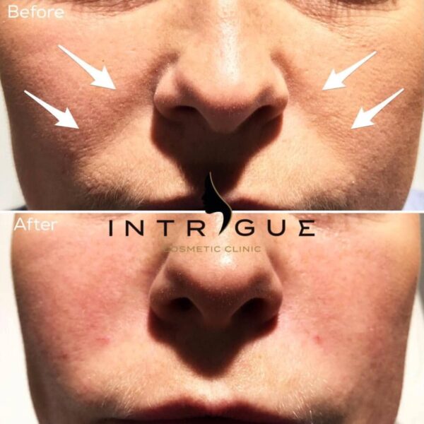 Treatment Results - Intrigue Cosmetic Clinic