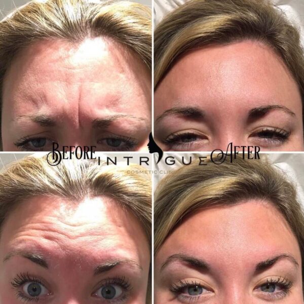 Treatment Results - Intrigue Cosmetic Clinic