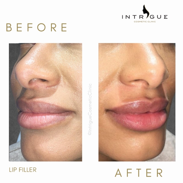 Dermal filler - Lips
