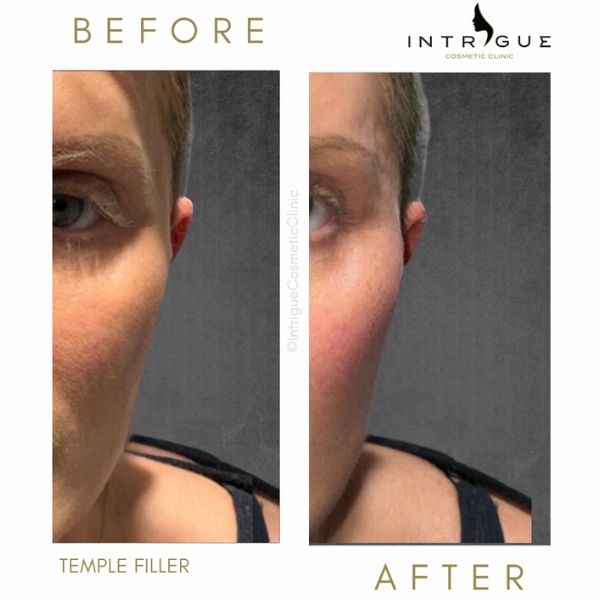 Dermal filler - Temples