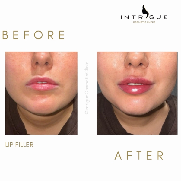 Derma filler - Lips