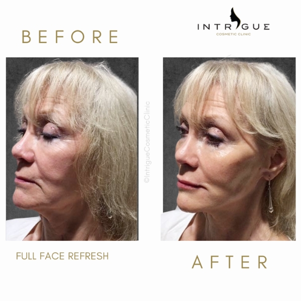 Derma filler - Cheeks and lips