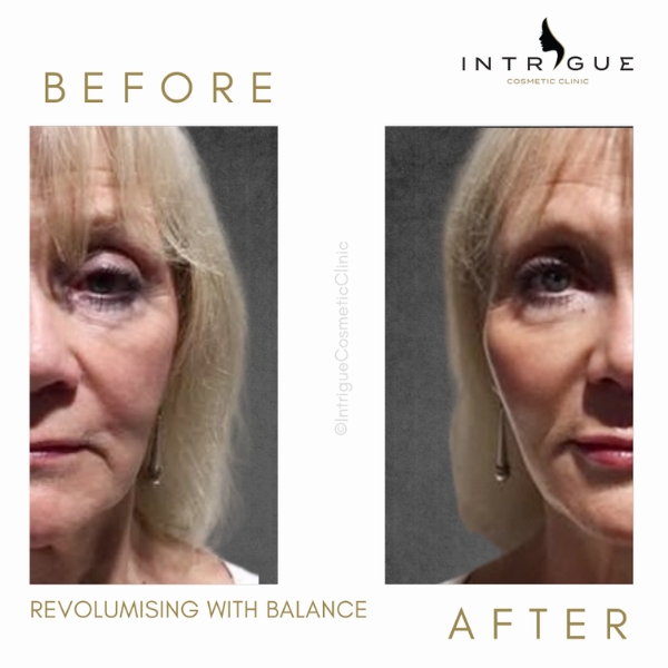Derma filler - Cheeks and lips