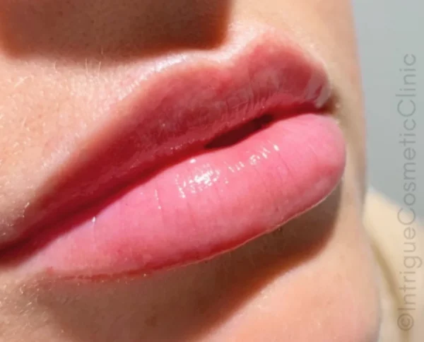 Blog - Intrigue Cosmetic Clinic